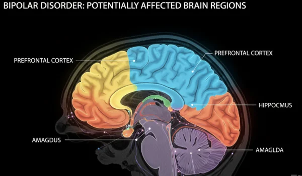MRI scan of a human brain showing areas affected by bipolar